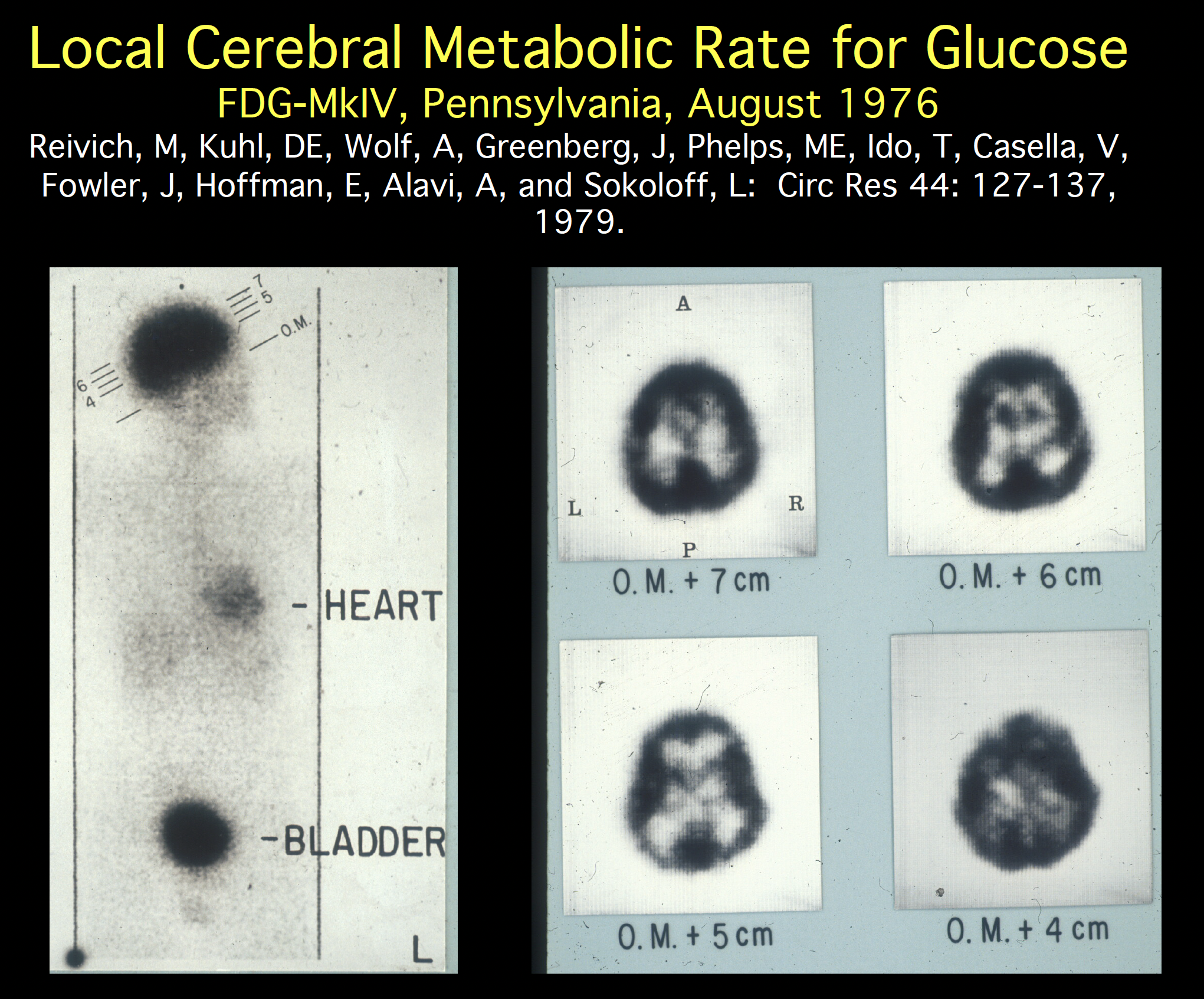 First human FDG scan showing whole-body and cross-sectional brain images